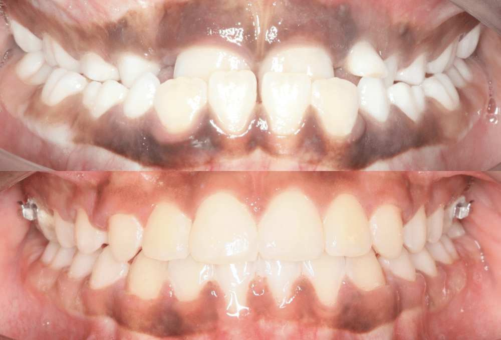 La gestion interceptive des Classes III – Formation en orthodontie